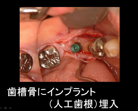 歯槽骨にインプラント（人工歯根）を埋入