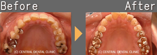 虫歯治療症例