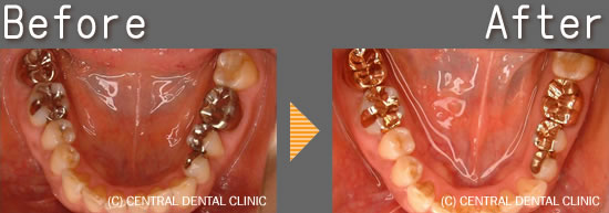 虫歯治療症例